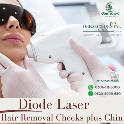Diode Laser Hair Removal for Cheeks Plus Chin