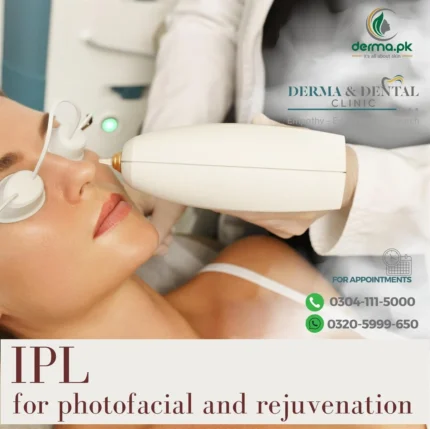 IPL for Photofacial and Rejuvenation