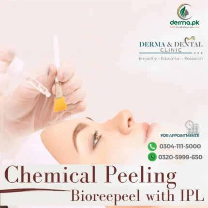 Peeling Bioreepeel and IPL